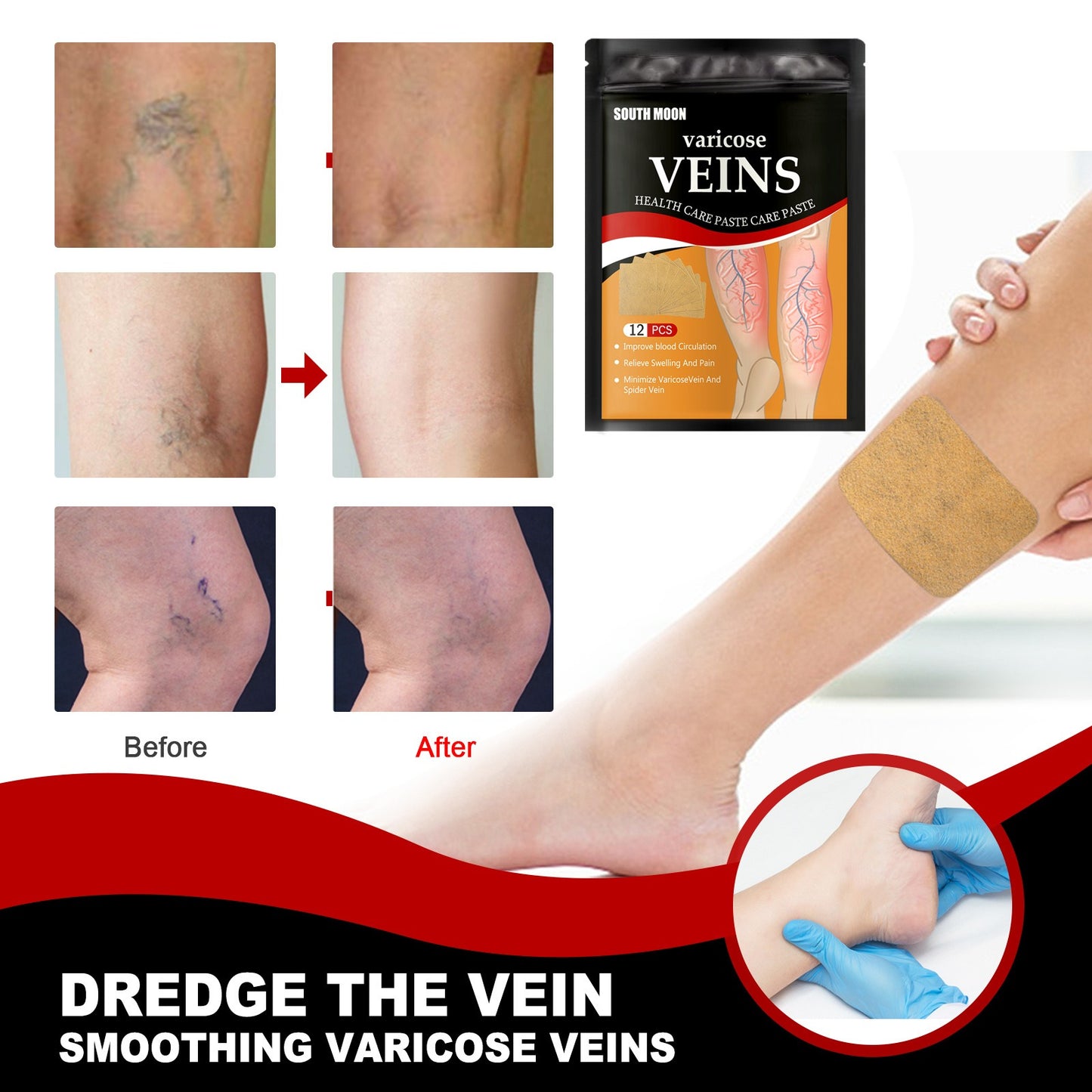 Venous health patch relieves varicose blood vessel blockage and protrusions in the feet. Cold compress venous health patch